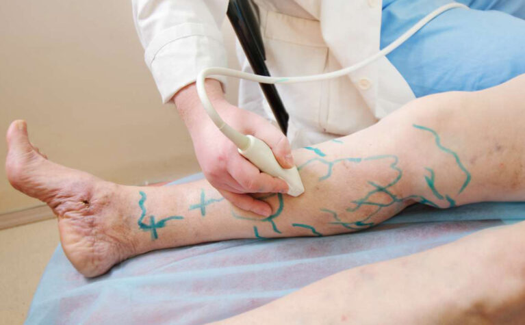 ameliyatsiz-varis-tedavisi-01