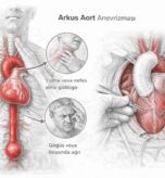 Arkus-Aort-Anevrizmasi